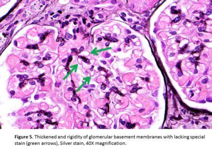 spike and dome appearance kidney|Treatment of membranous nephropathy with crescent nephritis by .